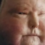 Burn unit patient receiving treatment